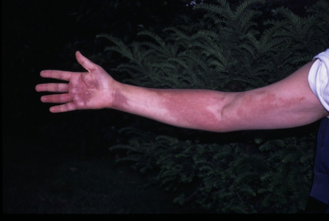 braço depois de vibora